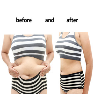 Abdominoplasty